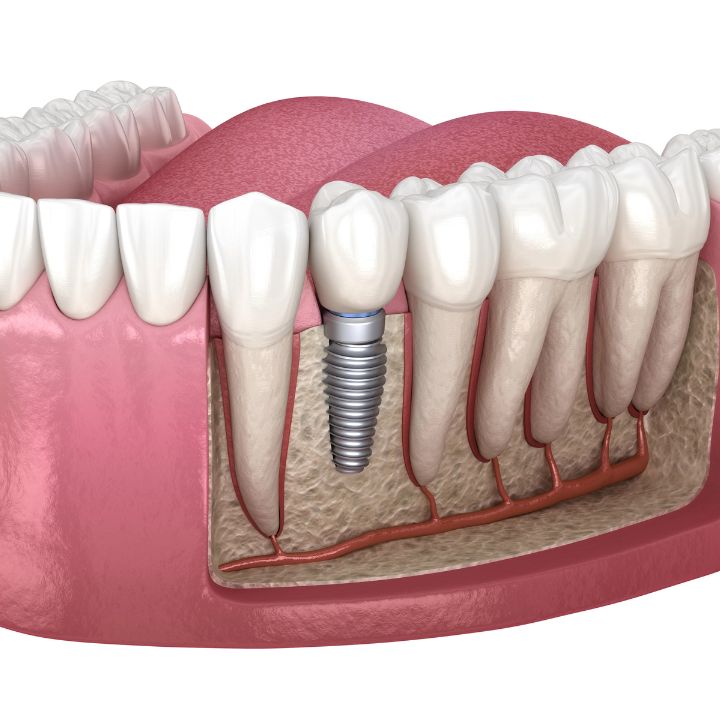 Ceramic Dental Implants Stafford VA